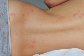 bed bug bites looking like tiny swellings on the back of a person